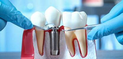 Invisalign in Goregaon